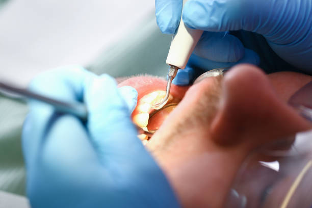 Best Emergency Tooth Extraction in Bratenahl, OH